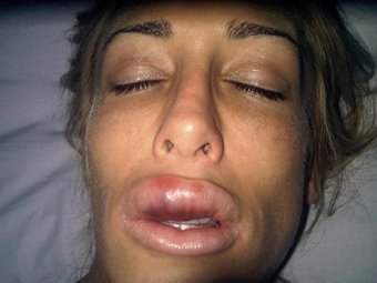 Лаура Саммерс после увеличения губ.