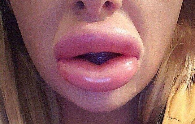 Фото: После косметической процедуры губы бабенки превратились в сосиски